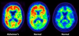 Alzheimer's Affected by Cholesterol Level