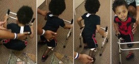 2-year-old amputee takes first steps with a prosthet