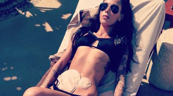 Woman Poses in Bikini with Colostomy Bags