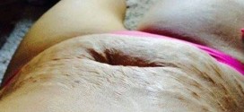 Alberta woman responds to stretch mark taunters on Facebook