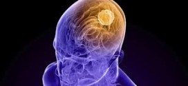 Scientists Explain Why Brain Tumors Occur More Often In Males