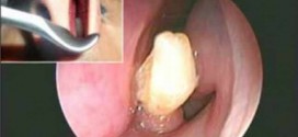 Tooth In Man's Nose : Doctors Find Extra Tooth in Really Odd Place