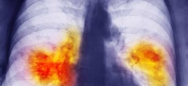 US lung cancer rates falling overall, Study