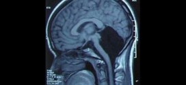 24-year old woman discovers part of her brain is missing