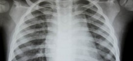 Texas: 700 infants exposed to TB at hospital