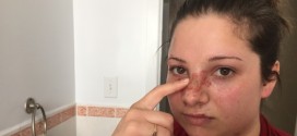 Nova Scotia woman recovering from burns after pizza slice assault