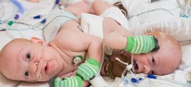 Conjoined twins separated in 12-hour operation (Video)