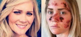 Tawny Willoughby : Woman's Skin Cancer Selfie Goes Viral