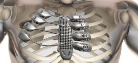 Spanish cancer patient receives world's first 3D-printed Titanium rib cage