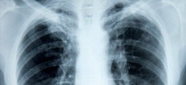 Alberta study aims to catch lung cancer earlier