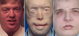 Patrick Hardison: Face Transplant Surgeons Make History And Change A Man's Life