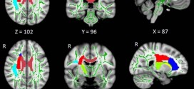 Insomnia Linked to Damage in Brain Communication Networks, New Study