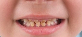 Tooth decay disease most common reason for day surgery on children, U of C study