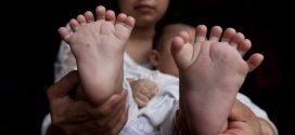 Baby born with 31 fingers, toes, parents seek help (Photo)