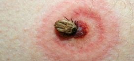 Risk Of Lyme Disease Low, Toronto Public Health says