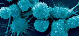 Prostate cancer scientists find genetic fingerprint identifying how; when disease spreads